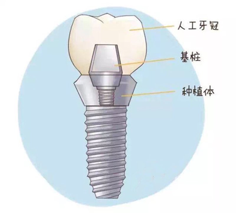 隐形矫正：让微笑不再受限于金属