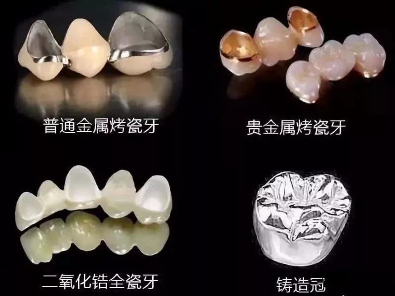 牙齿矫正——让笑容更加自信