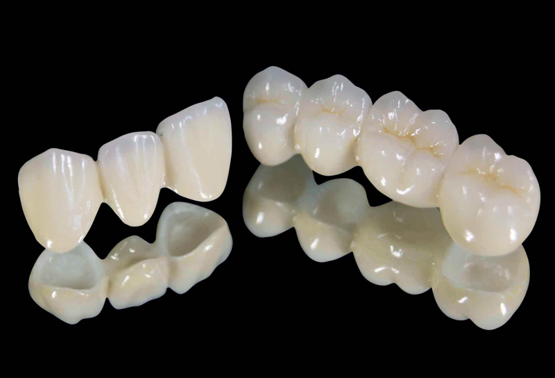 矫正牙齿的重要性与选择方案解析
